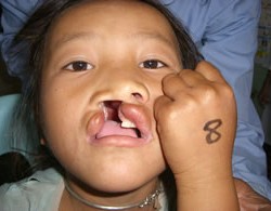 January 2008 – Plastic surgery mission